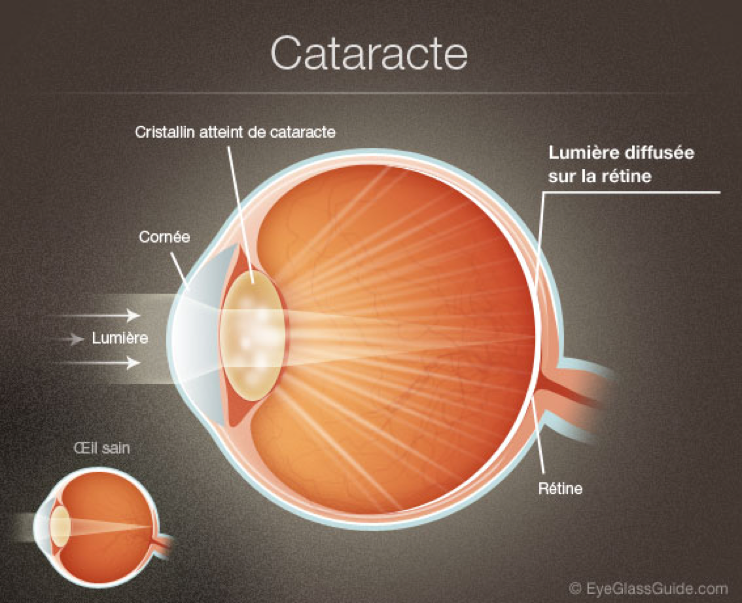 Schéma de la chirurgie de la cataracte