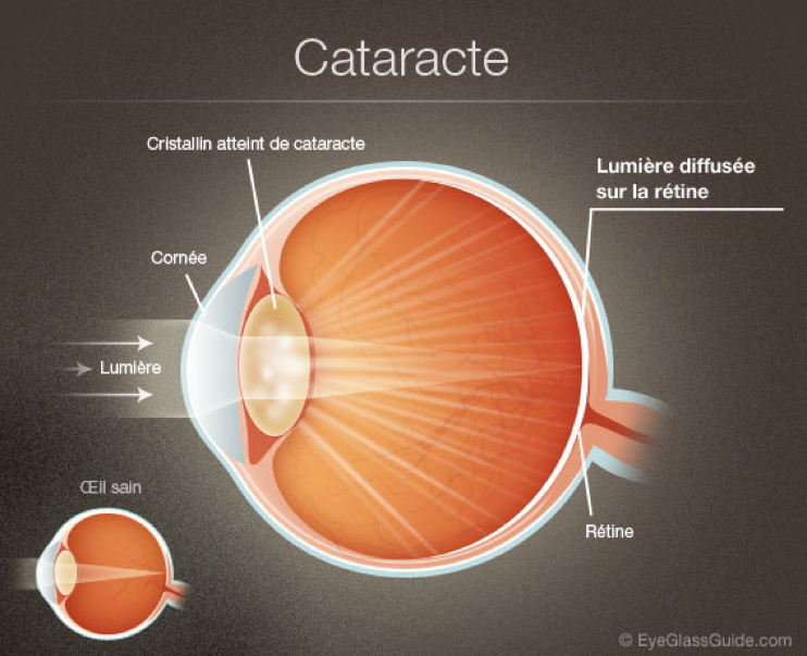 Chirurgie cataracte | Dr Temstet Chirurgien Ophtalmologue à Paris 17