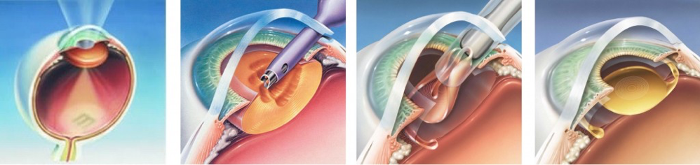 Étapes de la chirurgie de la cataracte